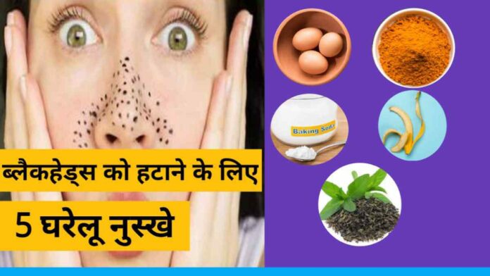 Home remedies to remove black spots or black heads from face